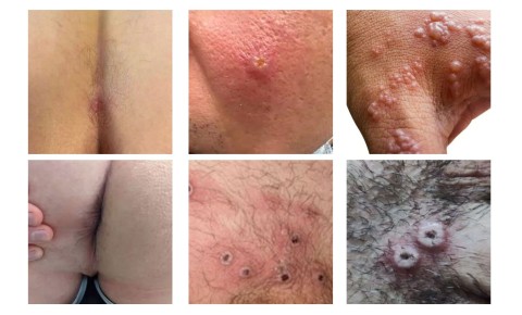 Zes voorbeelden van monkeypox (apenpokken): blaasjes en bultjes van verschillende vormen en maten.